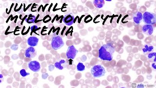 Juvenile Myelomonocytic Leukemia JMML Peripheral Blood Smear 2 year old Hematology amp Hemepath [upl. by Annairda709]