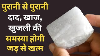 दाद खाज खुजली को जड़ से खत्म करने का 100 घरेलू उपाय  Natural way to get rid of itching  Khujli [upl. by Dohsar951]