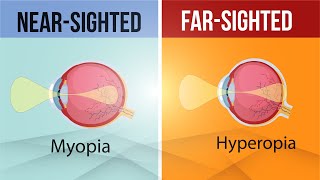 Difference in Myopia and Hyperopia  Nearsighted and FarSighted Lens  Class 10  Letstute CBSE [upl. by Ahsia]