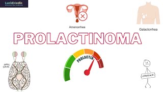 PROLACTINOMA  CAUSES MORPHOLOGY FEATURES AND TREATMENT pathologymedicinerobbinsdavidson [upl. by Nido]