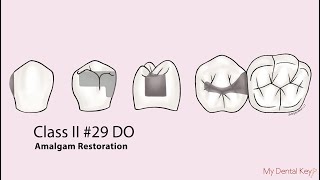 Class II amalgam restoration  My Dental Key [upl. by Lennaj600]