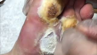 Pedicure video17，vertical plantaris，plantar wart [upl. by Ynnod]