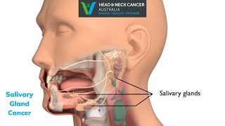 Salivary Gland Cancer  What Is It What are the Symptoms and Treatment Head and Neck Cancer [upl. by Klemperer384]