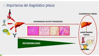 GASTROENTEROLOGÍA 18 Esteatosis hepática metabólica [upl. by Eelinnej430]