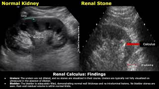 Renal Stone Kidney Ureter amp Bladder KUB Ultrasound Report Example  Renal Calculus USG Scan [upl. by Asilec]