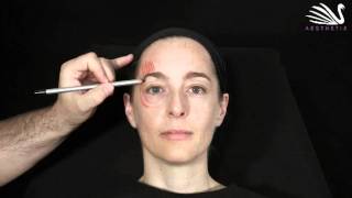 4  Eyebrowlift mit Botox  Dr Günther [upl. by Sella]