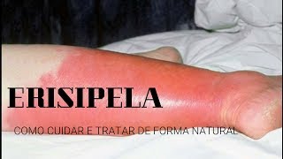 ERISIPELA  Saiba como cuidar e tratar de forma natural  Dr Edelson Beling [upl. by Noryv876]