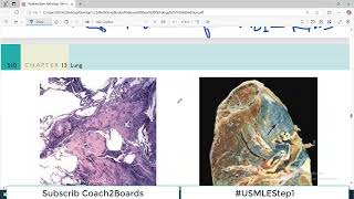 Chp13 Robbins Patho  Lung Pathology  Coal Worker Pneumoconiosis  Restrictive Lung Disorders [upl. by Roach]