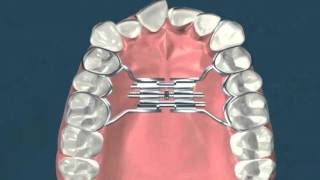 Expasion palatina rapida  Ortodoncia [upl. by Jonas589]