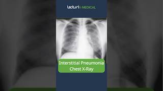 Understanding Interstitial Pneumonia 🫁 MedicalEducation usmle [upl. by Pembrook340]