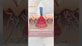 How does Exilis Ultra 360 work praha exilis [upl. by Agnella]