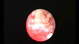 hysteroscopic treatment of osteoid metaplasia [upl. by Arrio]