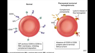 Paroxysmal nocturnal hemoglobinuria [upl. by Wavell986]