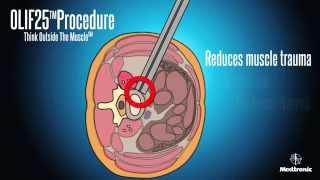 OLIF25 animation 斜側前脊椎融合手術 oblique lumbar interbody fusion Minimal invasive 微創腰椎融合手術 [upl. by Amaerd]