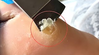 Callus removal from feetampFoot scraping dead skin【Xiao Yan pedicure】stress 816 [upl. by Yarrum]