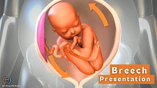 Breech presentation  Feet down baby position [upl. by Vivienne]