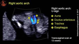 Fetal echocardiography at 1113 weeks Right Aortic Arch RAA [upl. by Reece]