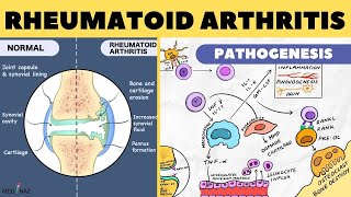 Rheumatoid Arthritis Pathophysiology  Rheumatoid Arthritis Pathogenesis  Arthritis pathophysiology [upl. by Trabue]