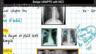 BELAJAR UKMPPD PULMONOLOGI PART 3 Pneumonia Bronchiolitis et al Pneumoconiosis Bagossosis [upl. by Goodwin]