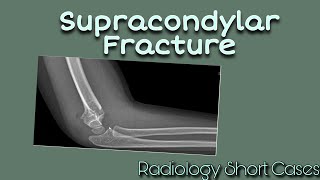 Supracondylar Fracture  Plain Radiograph  Radiology Short cases [upl. by Sumner]