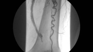 ANGIOPLASTIA CON STENT DE ARTERIA FEMORAL PROFUNDA 3 [upl. by Atekihs656]