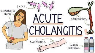 Understanding Acute Cholangitis Ascending Cholangitis [upl. by Edward]