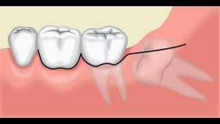 Auto Transplantation – A Viable Option of Saving Teeth [upl. by Orr490]