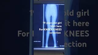 Patient visited for knock knees correction 2 months complete recoveryknockknees knockknee [upl. by Nitsrik]