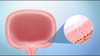 Treatment for Bladder Cancer [upl. by Jennica790]