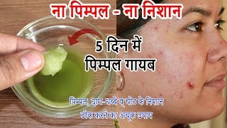 पुराने से पुराने पिम्पल्सदागधब्बे व किसी भी तरह के निशान हटाए  Remove Pimple  Acne Treatment [upl. by Adnerak]