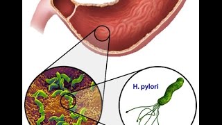 Helicobacter Pylori [upl. by Borroff]