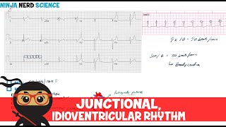 Rate and Rhythm  Junctional and Idioventricular Rhythm [upl. by Silisav]