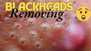 Satisfying Blackheads Removal 😲😯 Blackheads problem blackheads blackheadextraction satisfying [upl. by Leidag]