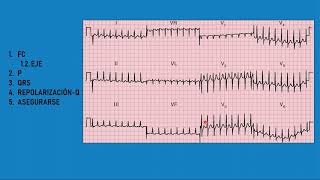 EJEMPLOS PRÁCTICOS DE ELECTROCARDIOGRAMAS [upl. by Sabra477]