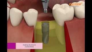 OSSTEM IMPLANT TSIII System Surgical Procedure Taper Kit and Straight Drill Kit [upl. by Ovid]