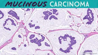 Primary Cutaneous Mucinous Carcinoma amp Endocrine MucinProducing Sweat Gland Carcinoma [upl. by Giustina956]