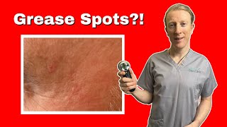 How to Get Rid of Sebaceous Hyperplasia Complete Guide to Sebaceous Hyperplasia [upl. by Jevon]