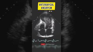 Large Anteroapical Aneurysm  Echocardiography For Beginners cardiology echocardiogram [upl. by Namya]