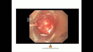 Traitement endoscopique des complications de la chirurgie œsogastrique [upl. by Hal]