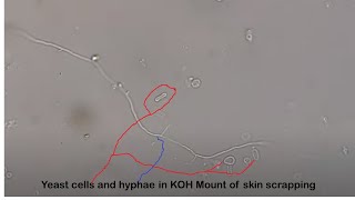 Yeast cells and hyphae in KOH Mount of skin scrapping [upl. by Etteluap]