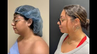 Watch Her Transform Chin Lipo Results [upl. by Gnet]