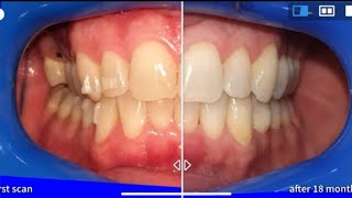 Invisalign treatment before and after with Virtual tracking time lapse [upl. by Aikyn796]