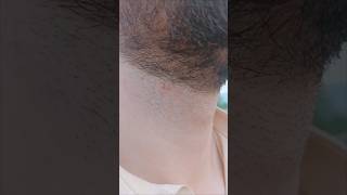 Who are facing this problem after shaving beard neckline hairbeard beardloveviralvideoviralvideo [upl. by Wise]