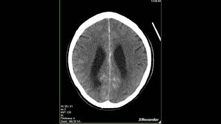 Subarachnoid hemorrhage SAH CT scan [upl. by Nallak697]