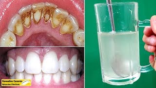 Eliminar La Placa Dental Y El Sarro Rápidamente Sólo Con Estos 3 Ingredientes Naturales [upl. by Fax]