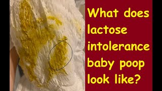 What does lactose intolerance baby poop look like [upl. by Cirala357]