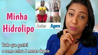 HIDROLIPO  VALORES E COMO ESTOU 6 MESES DEPOIS  Parte 3 [upl. by Ruder472]