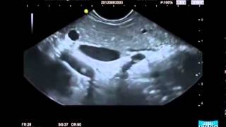 Endosonography in Autoimmune Pancreatitis [upl. by Orvie]