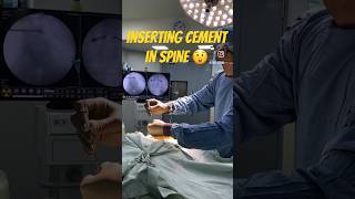 Watch this 👉 Inserting Cement in Spine 😮 Vertebroplasty [upl. by Akihsal]