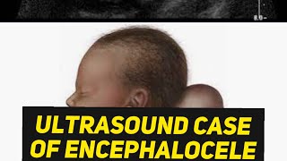 Encephalocele or Cystic Hygroma  Learn ultrasound [upl. by Henry]